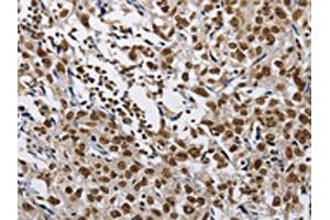 The image on the left is immunohistochemistry of paraffin-embedded Human esophagus cancer tissue using ABIN7128978(CMTM2 Antibody) at dilution 1/60, on the right is treated with fusion protein. (CMTM2 antibody)