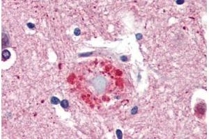 Human Brain, Cortex, Senile Plaque (formalin-fixed, paraffin-embedded) stained with Ubiquitin antibody ABIN462097 at 10 ug/ml followed by biotinylated goat anti-rabbit IgG secondary antibody ABIN481713, alkaline phosphatase-streptavidin and chromogen. (Ubiquitin antibody)