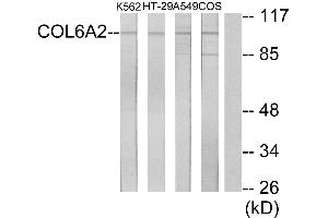 Immunohistochemistry analysis of paraffin-embedded human lung carcinoma tissue using Collagen VI α2 antibody. (COL6A2 antibody)