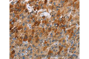 Immunohistochemistry of Human thyroid cancer using CCR9 Polyclonal Antibody at dilution of 1:40 (CCR9 antibody)