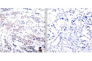 Immunohistochemical analysis of paraffin- embedded breast carcinoma. (ELK1 antibody  (Ser383))