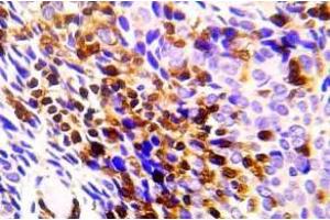 Immunohistochemistry (IHC) analyzes of CHK1 pAb in paraffin-embedded human lung adenocarcinoma tissue. (CHEK1 antibody)