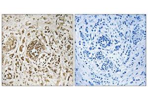 Immunohistochemistry analysis of paraffin-embedded human breast carcinoma tissue, using CIB2 antibody. (CIB2 antibody  (Internal Region))