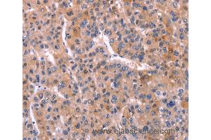 Immunohistochemistry of Human liver cancer using TNFRSF17 Polyclonal Antibody at dilution of 1:30 (BCMA antibody)