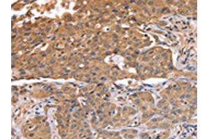 The image on the left is immunohistochemistry of paraffin-embedded Human lung cancer tissue using ABIN7128119(ABCB6 Antibody) at dilution 1/15, on the right is treated with fusion protein. (ABCB6 antibody)