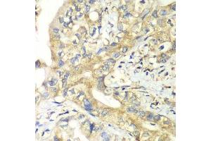 Immunohistochemistry of paraffin-embedded human liver cancer using TIMM17A antibody. (TIMM17A antibody  (AA 1-171))