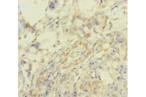Immunohistochemistry of paraffin-embedded human pancreatic cancer using ABIN7164521 at dilution of 1:100 (SMARCA2 antibody  (AA 700-1216))
