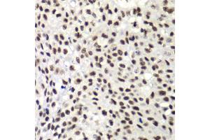 Immunohistochemistry of paraffin-embedded human lung cancer using NELFE antibody (ABIN6289947) at dilution of 1:100 (40x lens). (RDBP antibody)