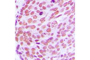 Immunohistochemical analysis of Lamin A/C staining in human breast cancer formalin fixed paraffin embedded tissue section. (Lamin A/C antibody  (Center))