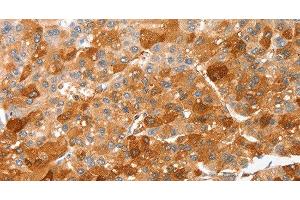 Immunohistochemistry of paraffin-embedded Human liver cancer using CIDEC Polyclonal Antibody at dilution of 1:50 (CIDEC antibody)