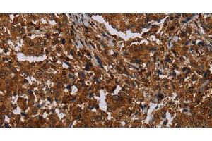 Immunohistochemistry of paraffin-embedded Human liver cancer tissue using MAGEB18 Polyclonal Antibody at dilution 1:30 (MAGEB18 antibody)