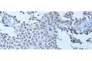 Immunohistochemistry of paraffin-embedded Human ovarian cancer tissue using ZNF703 Polyclonal Antibody at dilution of 1:55(x200) (ZNF703 antibody)