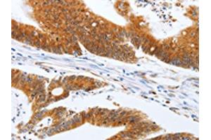 The image on the left is immunohistochemistry of paraffin-embedded Human colon cancer tissue using ABIN7131154(SPATA13 Antibody) at dilution 1/20, on the right is treated with fusion protein. (SPATA13 antibody)