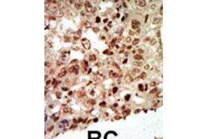 Formalin-fixed and paraffin-embedded human cancer tissue reacted with the primary antibody, which was peroxidase-conjugated to the secondary antibody, followed by AEC staining. (MAPK11 antibody  (AA 334-366))