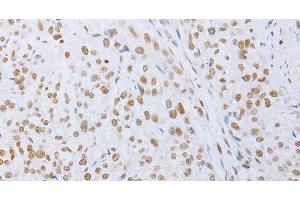 Immunohistochemistry of paraffin-embedded Human esophagus cancer tissue using MCM2 Polyclonal Antibody at dilution 1:50 (MCM2 antibody)