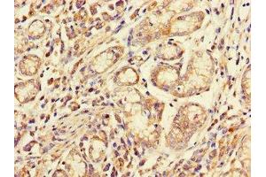 Immunohistochemistry of paraffin-embedded human gastric cancer using ABIN7158537 at dilution of 1:100 (FCGR2A antibody  (AA 241-317))