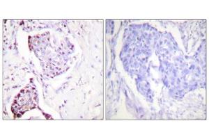 Immunohistochemistry analysis of paraffin-embedded human breast carcinoma tissue, using Ubiquitin antibody. (Ubiquitin antibody  (Internal Region))