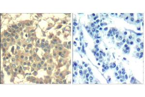 Immunohistochemical analysis of paraffin-embedded human breast carcinoma tissue using Met (Ab-1003) Antibody (E021548). (c-MET antibody)