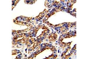 IHC analysis of FFPE human prostate carcinoma with TROP2 antibody (TACSTD2 antibody  (AA 162-190))