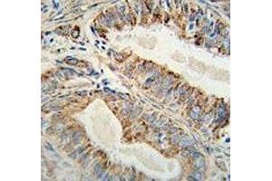 Anti-AKT2 antibody immunohistochemistry analysis in formalin fixed and paraffin embedded human prostate carcinoma. (AKT2 antibody)