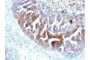 Formalin-fixed, paraffin-embedded human ovarian carcinoma stained with TAG-72 antibody (B72. (TAG-72 antibody)