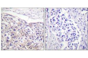 Immunohistochemical analysis of paraffin-embedded human breast carcinoma tissue using p90 RSK (Phospho-Thr573) antibody (left)or the same antibody preincubated with blocking peptide (right). (RPS6KA1 antibody  (pThr573))