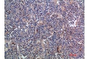 Immunohistochemical analysis of paraffin-embedded human-kidney-cancer, antibody was diluted at 1:200. (EGF antibody  (AA 1000-1060))