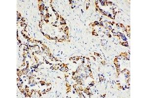 IHC-P: Paxillin antibody testing of human lung cancer tissue (Paxillin antibody  (AA 456-472))