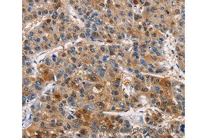 Immunohistochemistry of Human thyroid cancer using PIM1 Polyclonal Antibody at dilution of 1:40 (PIM1 antibody)