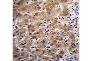 Glypican 3 antibody immunohistochemistry analysis in formalin fixed and paraffin embedded human liver tissue. (Glypican 3 antibody  (AA 21-50))