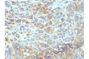 Formalin-fixed, paraffin-embedded human Melanoma stained with CD54 Monoclonal Antibody (W-CAM-1). (ICAM1 antibody)