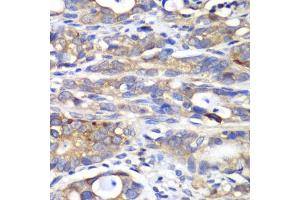 Immunohistochemistry of paraffin-embedded human gastric cancer using H antibody (ABIN6129787, ABIN6141601, ABIN6141603 and ABIN6216048) at dilution of 1:100 (40x lens). (HAPLN1 抗体  (AA 165-354))