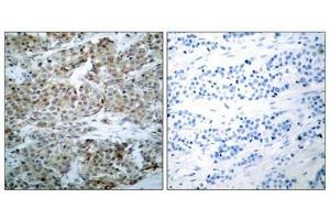 Immunohistochemical analysis of paraffin-embedded human breast carcinoma tissue using BAD(Phospho-Ser112) Antibody(left) or the same antibody preincubated with blocking peptide(right). (BAD antibody  (pSer112))