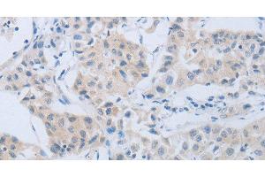 Immunohistochemistry of paraffin-embedded Human lung cancer using CD10 Polyclonal Antibody at dilution of 1:45 (MME antibody)