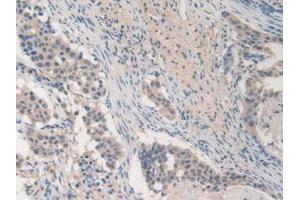 IHC-P analysis of Human Lung Cancer Tissue, with DAB staining. (MMP19 antibody  (AA 98-508))