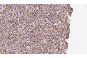 ABIN6273191 at 1/100 staining Human lymph cancer tissue by IHC-P. (alpha Adaptin antibody  (Internal Region))