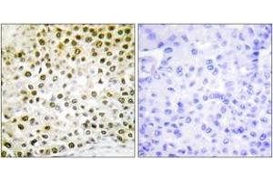 Immunohistochemistry analysis of paraffin-embedded human breast carcinoma tissue, using Histone H2B (Ab-15) Antibody. (Histone H2B antibody  (AA 11-60))