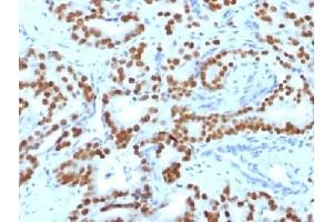 IHC testing of FFPE human prostate carcinoma with FOXA1 antibody (clone FOXA1/1519). (FOXA1 antibody  (AA 372-472))
