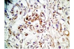 Human stomach cancer tissue was stained by rabbit anti-Spexin(H) Antiserum (Spexin antibody)