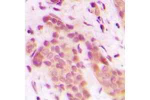 Immunohistochemical analysis of CDK8 staining in human breast cancer formalin fixed paraffin embedded tissue section. (CDK8 antibody  (N-Term))