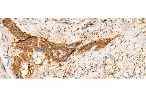 Immunohistochemistry of paraffin-embedded Human esophagus cancer tissue using SMUG1 Polyclonal Antibody at dilution of 1:50(x200) (SMUG1 antibody)