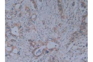 IHC-P analysis of Human Pancreas Cancer Tissue, with DAB staining. (Fibrillin 1 antibody  (AA 246-389))