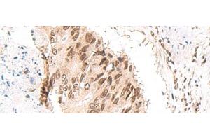 Immunohistochemistry of paraffin-embedded Human colorectal cancer tissue using CKMT1A/CKMT1B Polyclonal Antibody at dilution of 1:55(x200) (CKMT1 antibody)