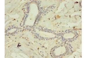 Immunohistochemistry of paraffin-embedded human breast cancer using ABIN7158507 at dilution of 1:100 (ACSL4 antibody  (AA 457-670))