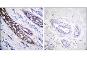 Immunohistochemistry analysis of paraffin-embedded human breast carcinoma tissue, using IRAK1 (Ab-209) Antibody. (IRAK1 antibody  (AA 175-224))