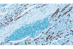 Human lung adenocarcinoma: immunohistochemical staining for Surfactant Protein A. (Surfactant Protein A1 antibody)