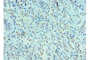Immunohistochemistry of paraffin-embedded human breast cancer using ABIN7148701 at dilution of 1:100 (CRY2 antibody  (AA 434-593))
