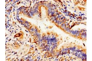 Immunohistochemistry of paraffin-embedded human lung cancer using ABIN7144912 at dilution of 1:100 (ABCD1 antibody  (AA 632-745))