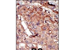 Formalin-fixed and paraffin-embedded human cancer tissue reacted with the primary antibody, which was peroxidase-conjugated to the secondary antibody, followed by AEC staining. (BRD2 antibody  (AA 170-200))