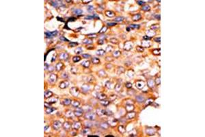 Formalin-fixed and paraffin-embedded human cancer tissue reacted with the primary antibody, which was peroxidase-conjugated to the secondary antibody, followed by AEC staining. (PANK3 antibody  (AA 150-181))